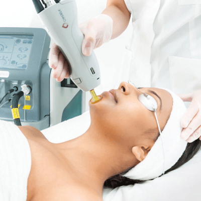 FACIAL LASER HAIR REMOVAL